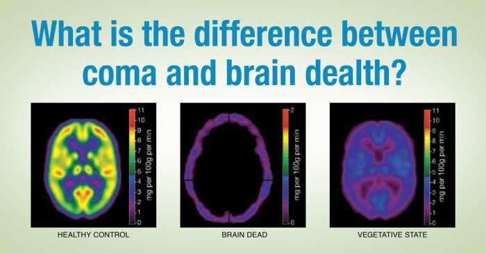 What is the Difference Between a Coma and Brain Death? | LifeSource