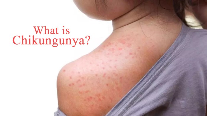 Chikungunya is on the move